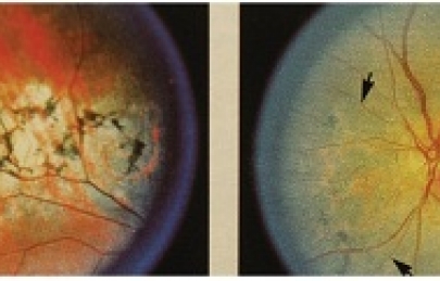 QUÁNG GÀ VÀ THOÁI HÓA SẮC TỐ VÕNG MẠC – TRIỆU CHỨNG, NGUYÊN NHÂN VÀ ĐIỀU TRỊ